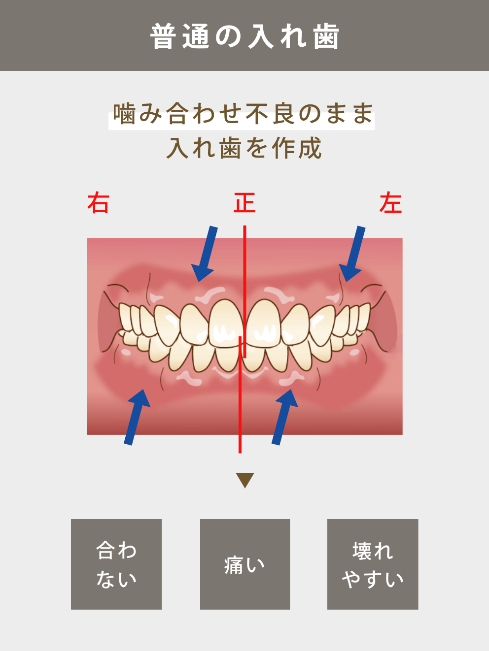 普通の入れ歯